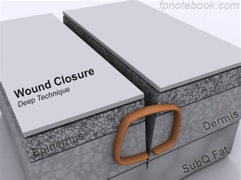 Purchase suture removal kit from certified sellers and manufacturers at alibaba.com. Wound Repair