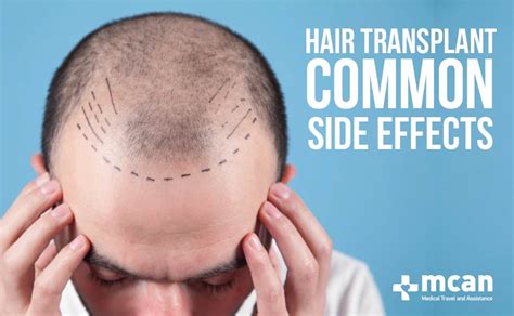 7 Common Hair Transplant Side Effects