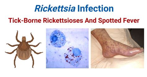 Rickettsia Infection Tick Borne Rickettsioses And Spotted Fever