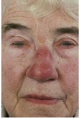 In this study, we retrospectively evaluated the clinical features of sarcoidosis patients with diagnosed lp at our center. Dermatology flashcards | Quizlet