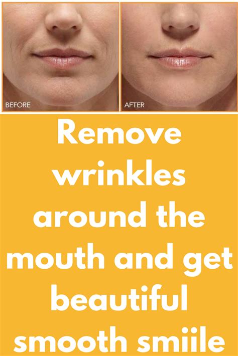 Remove Wrinkles Around The Mouth And Get Beautiful Smooth Smiile The