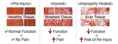 Musclestrainaftercaraccident ⋆ Santa Barbara Deep Tissue Riktr