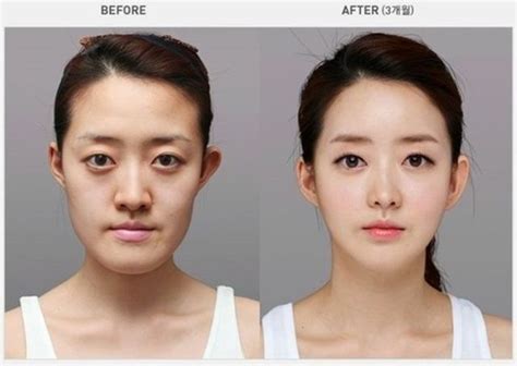 Before And After Photos Of Korean Plastic Surgery 30 PICS Izismile Com