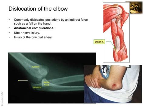 Imaging Anatomy Dislocation Of The Elbow