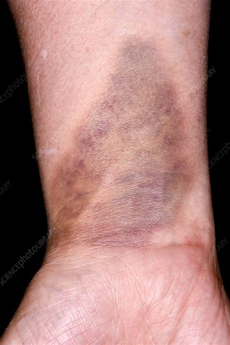 Bruise On Wrist Stock Image C0345486 Science Photo Library