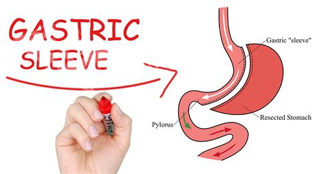 Sleeve Gastrectomy Procedure And All About It Healing Consulting Turkey