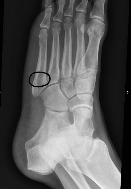 Fractures need to be immobilized in order for them to heal. Foot Care on the Trail: One Man's Battle with His Feet ...