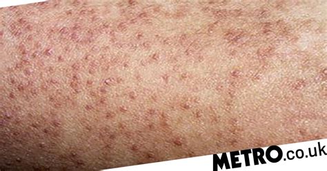 Best Products For Little Bumps Called Keratosis Pilaris On Your Legs