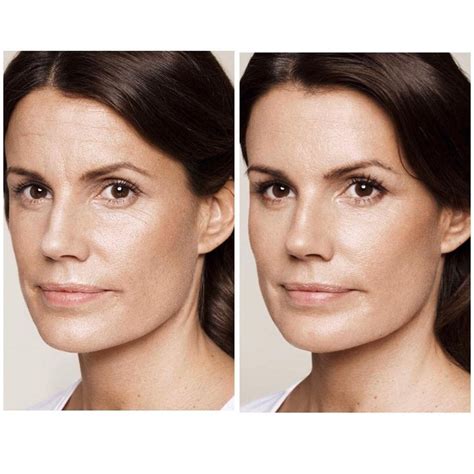 👉 Antes y Después de realizar tratamiento 👩🏼‍⚕💉 . Botox para eliminar