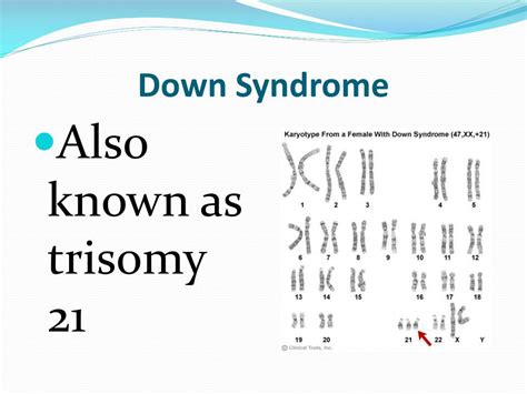 Ppt Down Syndrome Powerpoint Presentation Free Download Id5944198