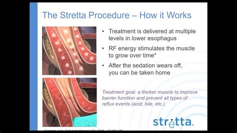 Stretta Patient Webinar Dr Reiss Youtube