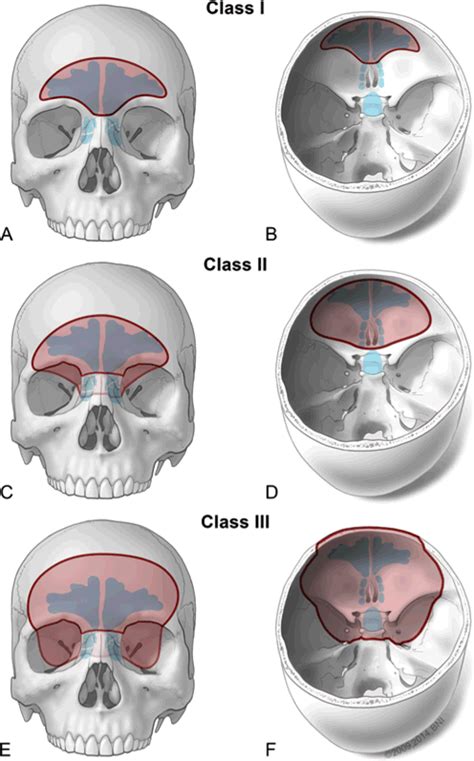 Extensive traumatic anterior skull base fractures with cerebrospinal
