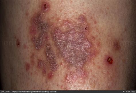 Stock Image Dermatology Psoriasis A Pinkish Spreading Patch With White