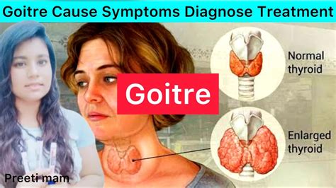 Goitre Cause Symptoms Diagnose Treatment Goitre What Is Goitre