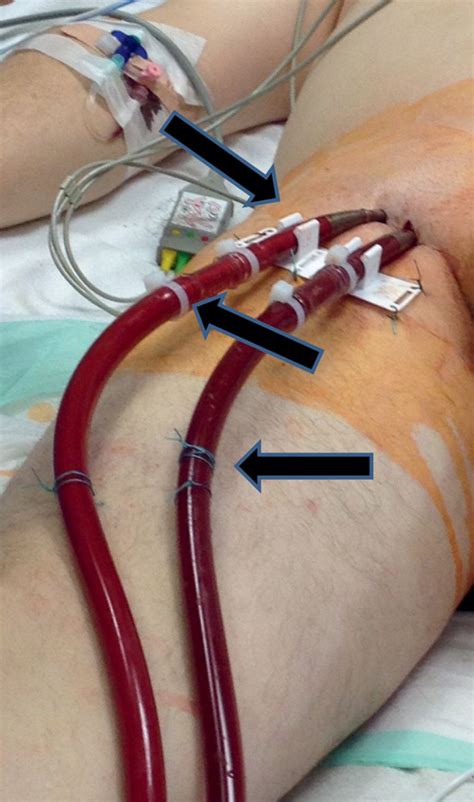 Ecmo cannulation course is organized by ecmo experts in egypt at the learning resource center, kasr al ainy , cairo, egypt. overview for musictomyomelette
