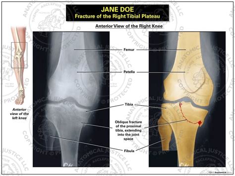 Fracture Of The Right Tibial Plateau