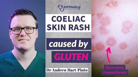 Dermatitis Herpetiformis Skin Rash Linked To Coeliac Disease Celiac