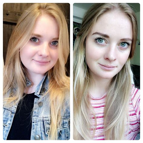 Hypothyroidism Face Before And After