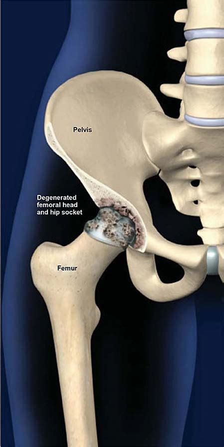 Degenerative Joint Disease Of The Hip Osteoarthritis Of The Hip