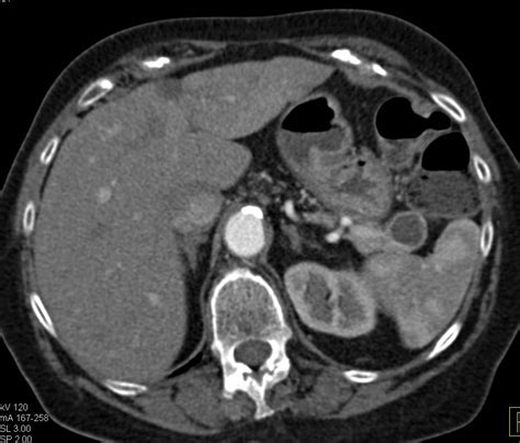 Cystic Neuroendocrine Tumor In Tail Of The Pancreas Pancreas Case My