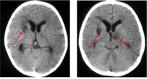 1 Tac Meningitis Ocronos Editorial Científico Técnica