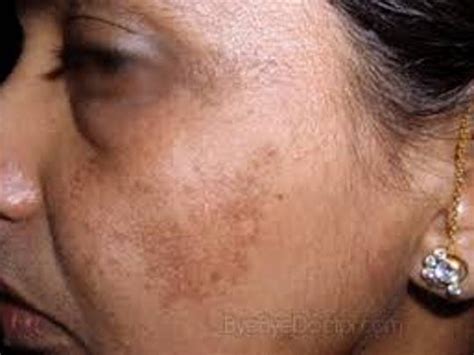 Dark Spots On Face Melasma
