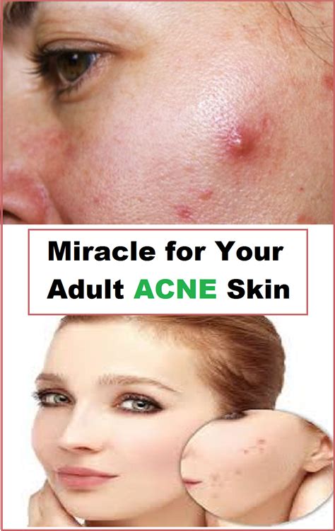 Miracle For Your Adult Acne Skin Adult Acne Adult Acne Treatments