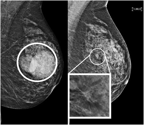 Mammographic Architectural Distortion Caused By Cyst Aspiration Noel