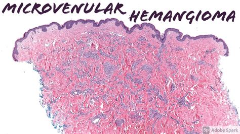 Microvenular Hemangioma 5 Minute Pathology Pearls Youtube