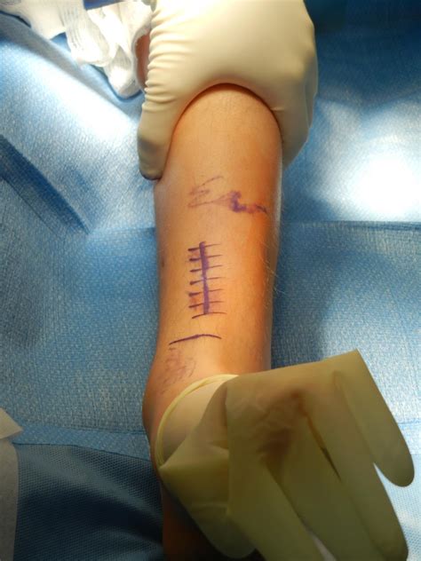 Tibia Anterior Approach Approaches Orthobullets
