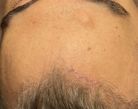 Plastic Surgery Case Study Single Port Endoscopic Forehead Osteoma