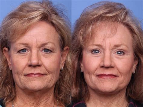 Blepharoplasty Before And After Pictures Case 345 Scottsdale Az