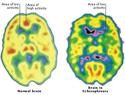 Includes trusted info on schizophrenia brain scans and brain images of schizophrenia. Medical Encyclopedia - Schizophrenia - Aviva