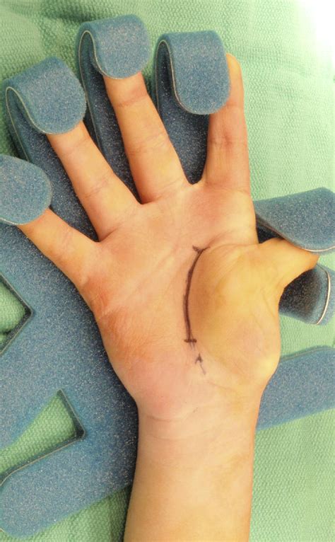 Surgical Technique For Thumb In Palm Deformity In Cerebral Palsy
