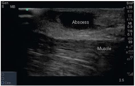 Skin Abscess Ultrasound