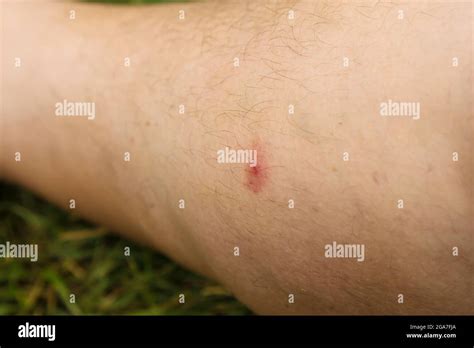 Gnat Bite Scratched Until It Bleeds On Mans Leg Summer 2021 Stock