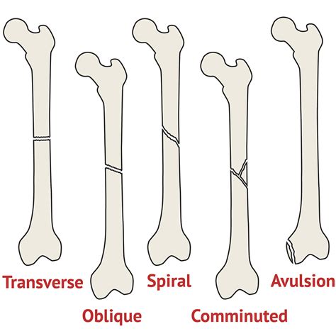 Types Of Fracture Ortho X Ray Medschool
