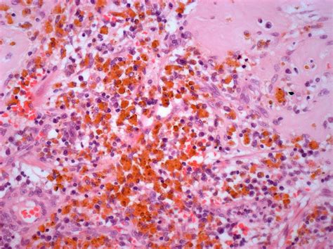 Malignant Melanoma Photograph By Steve Gschmeissner Pixels