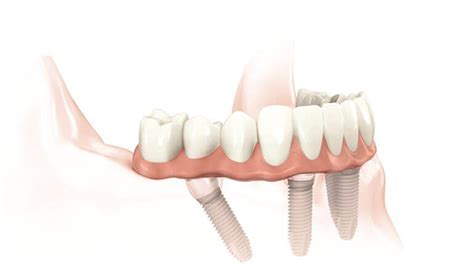 Teeth In A Day Dallas Tx Dental Implants