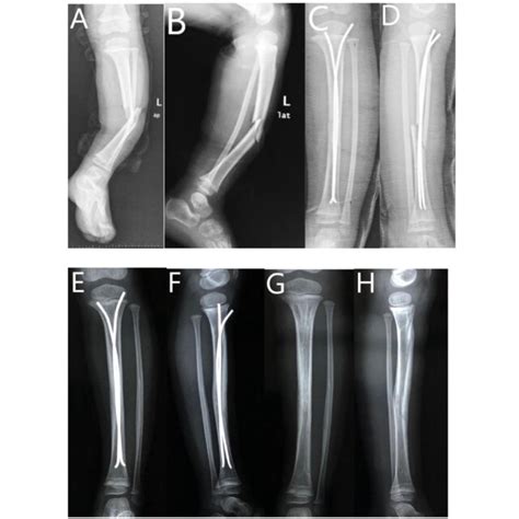 Six Year Old Boy With Gustilo Anderson Grade Ii Tibial Fracture Treated