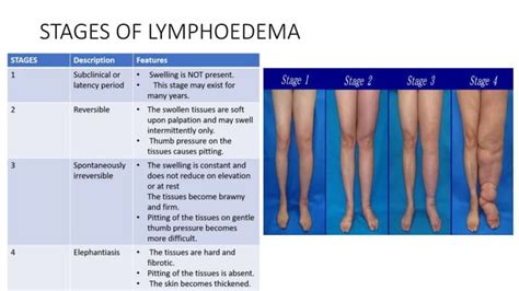 Lymphoedema Physiotherapy Management Ppt