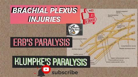 Brachial Plexus Injuries Erbs And Klumpkes Paralysis Youtube
