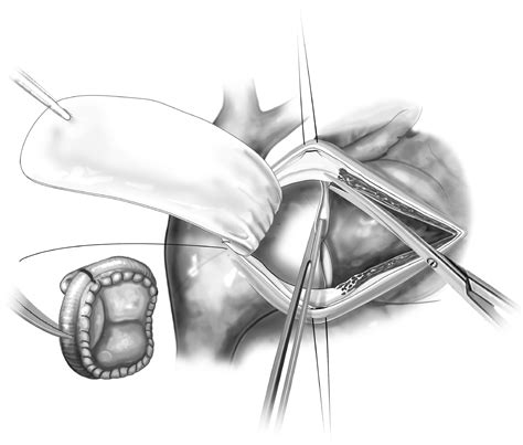 Bioprosthetic Pulmonary Valve Replacement Operative Techniques In