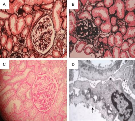 Light And Electron Microscopy Pictures Of The Renal Biopsy Taken From