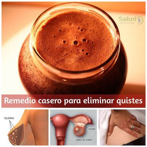 Lista 90 Imagen De Fondo Remedios Naturales Para Eliminar Miomas Y Quistes En Los Ovarios Cena