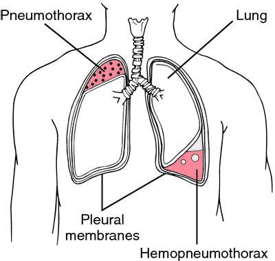 A pneumothorax can be caused by: Pneumothorax | definition of pneumothorax by Medical ...