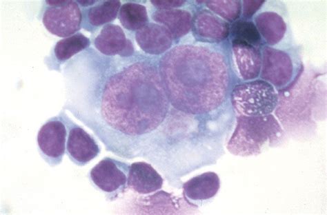 Blutgruppe und krebs des immunsystems. Reed-Sternberg cells / Hodgkin lymphoma | Hematology ...