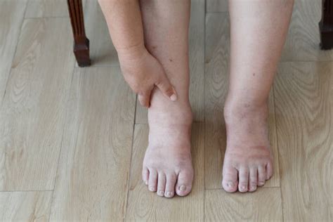 Senior Swollen Ankles Stock Photos Pictures And Royalty Free Images Istock