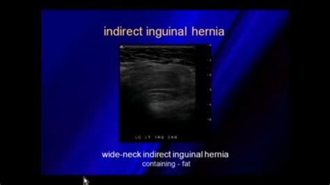 Ultrasound Of Hernias Ultrasound Pandora Pandora Screenshot