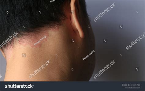 Psoriasis Skin Disease Causes Rash Itchy Stock Photo 2236094521